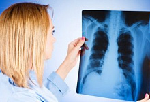 У 16 человек в Лунинецком районе в 2021 году обнаружен туберкулез легких